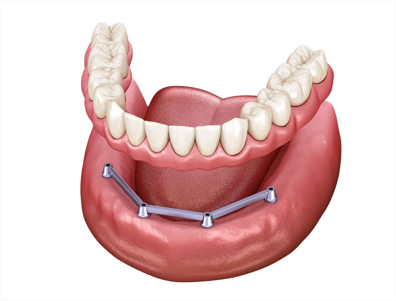Removable Mandibular prosthesis with gum All on 4 system supported by implants. Medically accurate 3D illustration of human teeth and dentures
