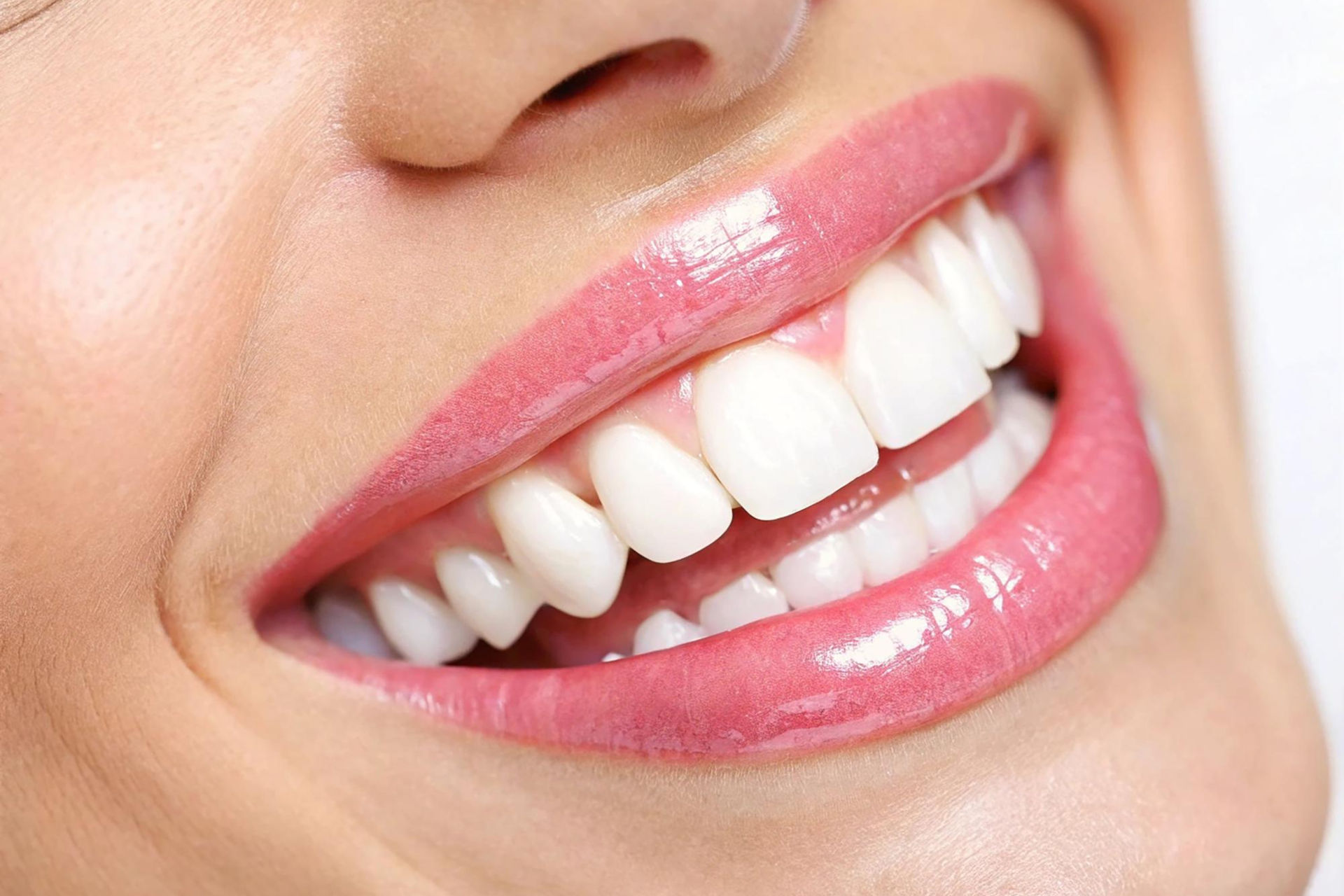 Veneers