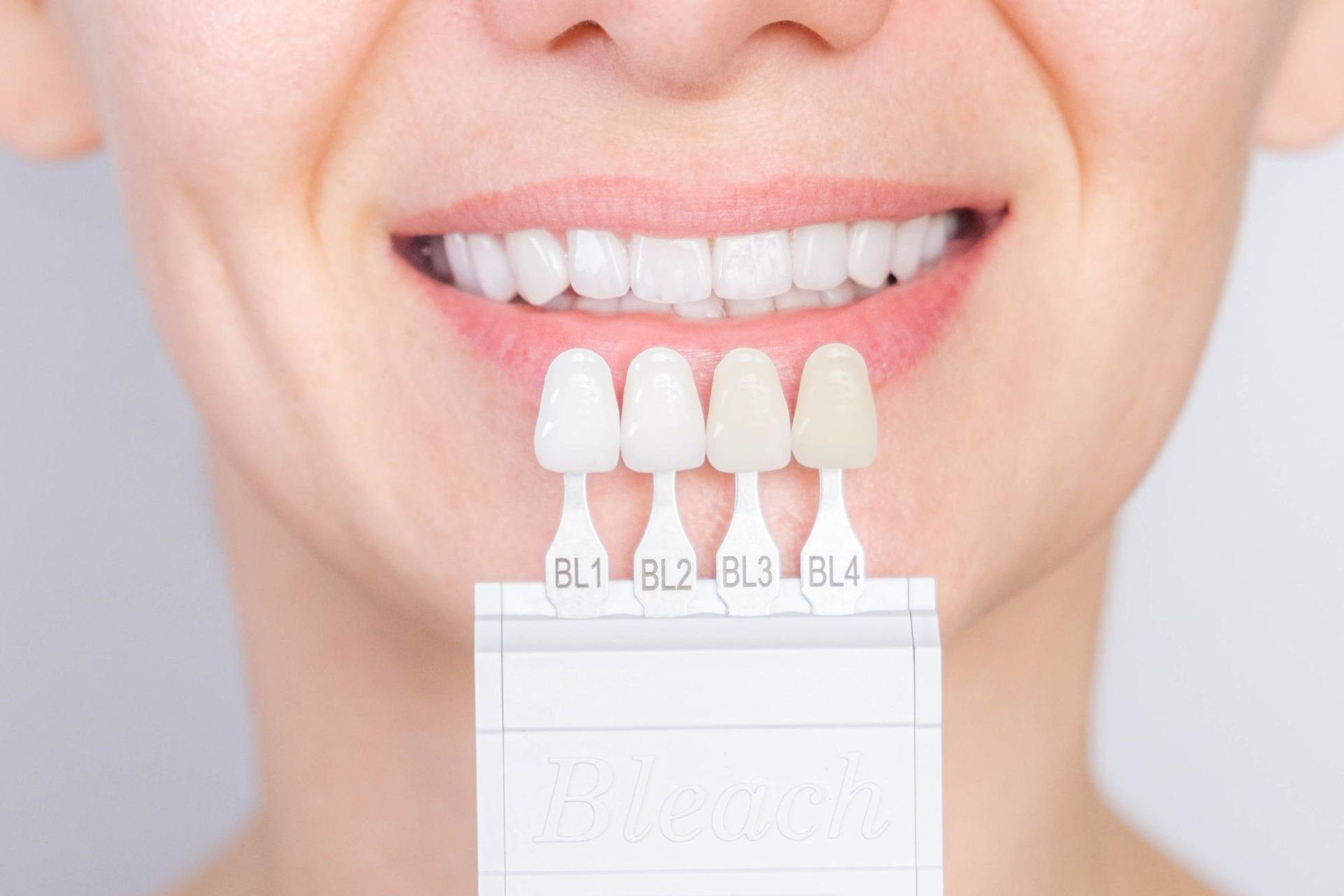 Veneers